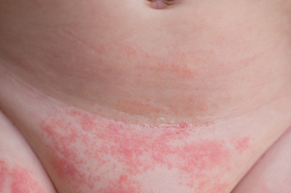 Causes Of Skin Rash In Children