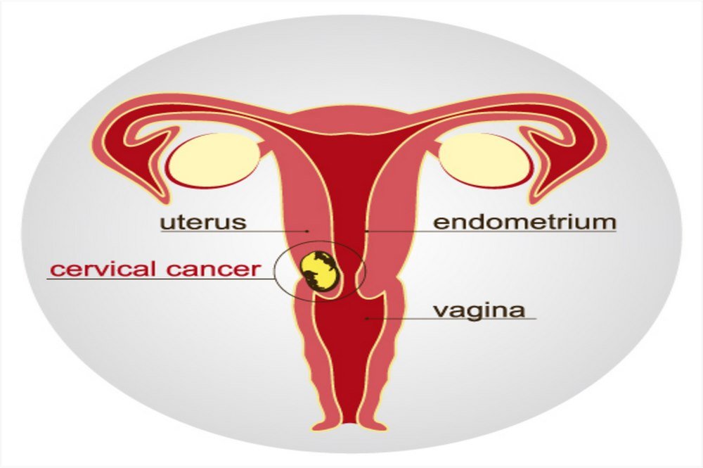 Cervical cancer