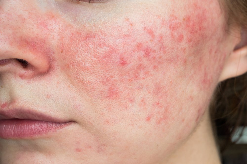 Chronic skin conditions