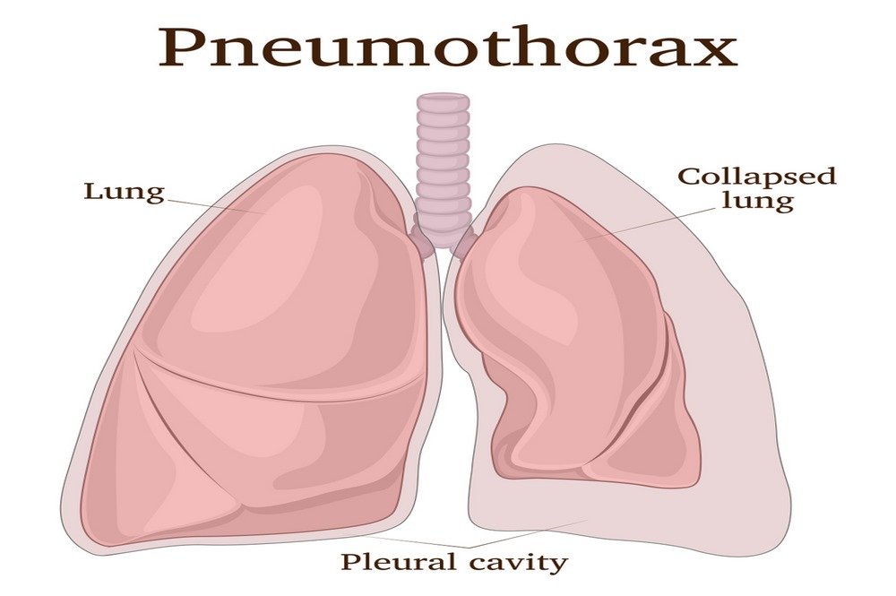 Collapsed lung (Pneumothorax)