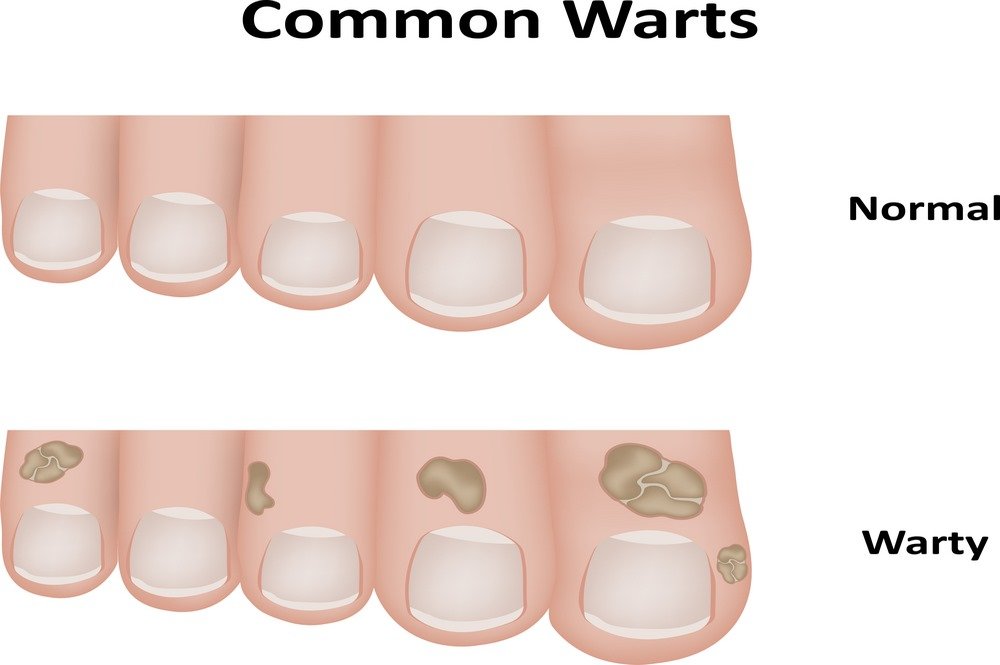 Common warts