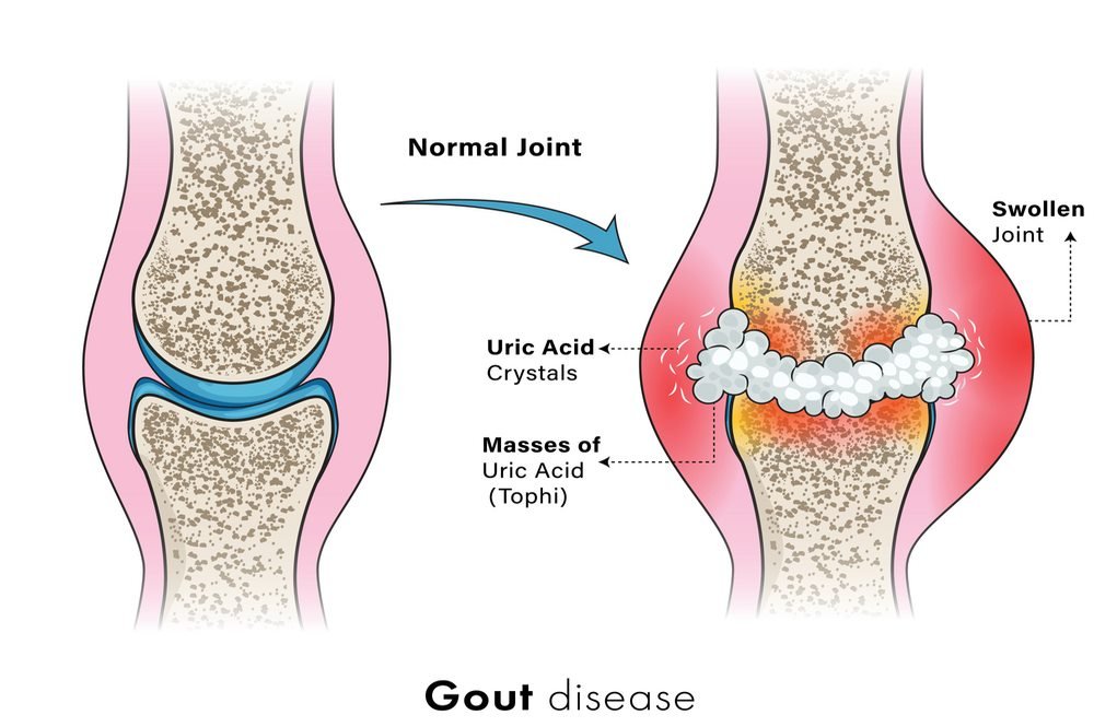 Gout Complications