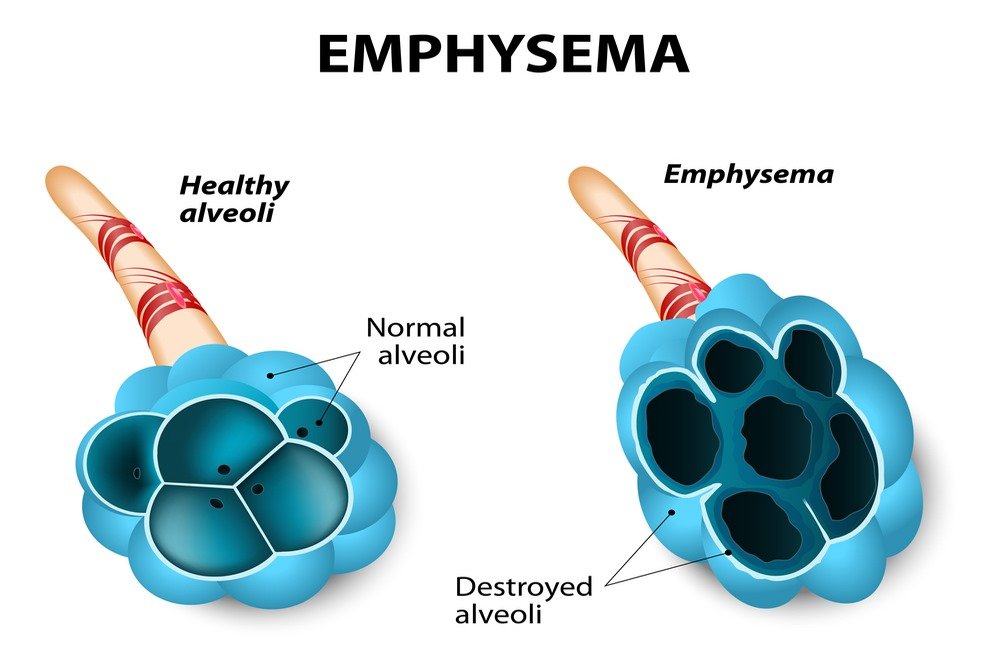 Emphysema : Definition, Symptoms, Causes, Diagnosis, Types, Stages, Life Expectancy, Pathophysiology, Medications, Complications and Treatment 