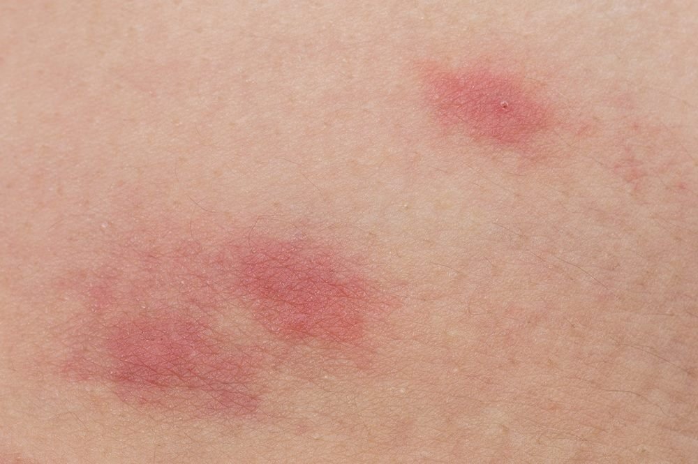 Flea bites rash