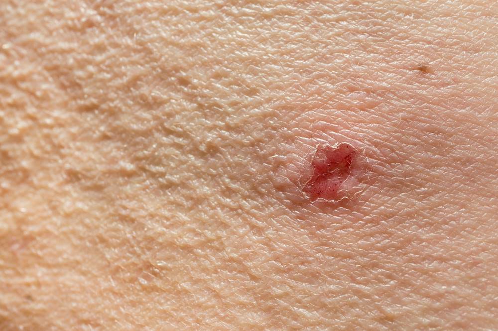 Hemorrhagic areas on the skin