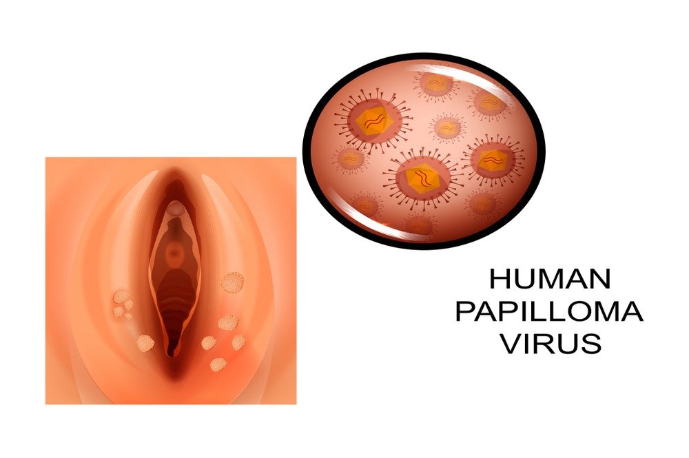 Human papillomavirus (HPV) : Definition, Symptoms ( man & Women ), Causes, Types, HPV Vaccine Advantages & Disadvantages, Treatment & Prevention