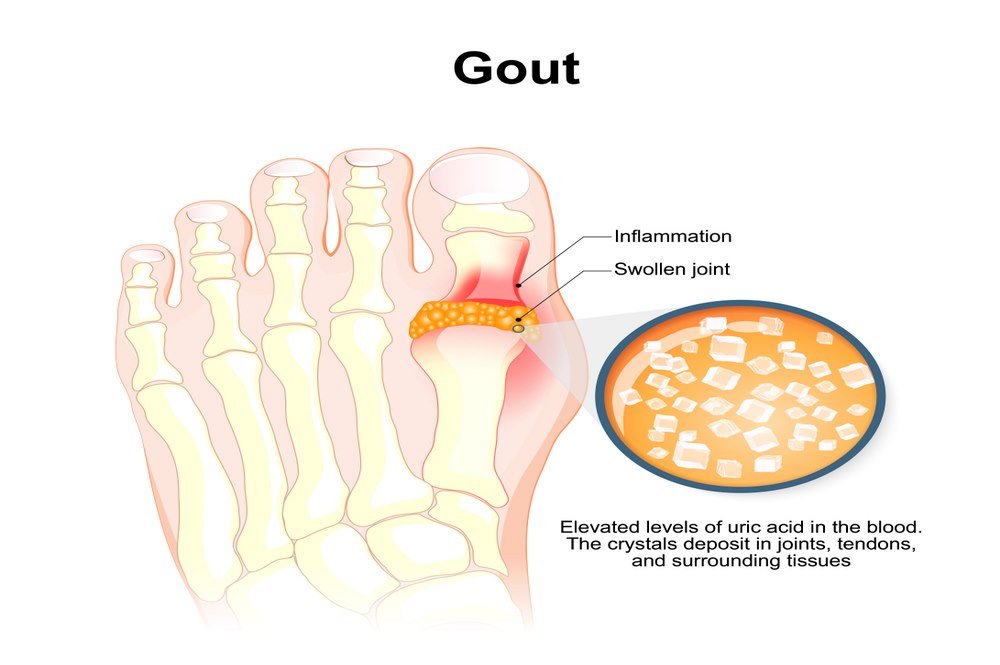 Interval or Inter-Critical Gout