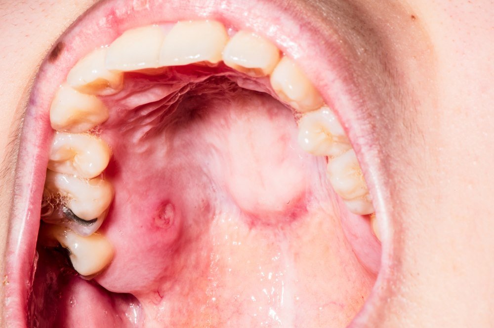 Lesions in the oral cavity