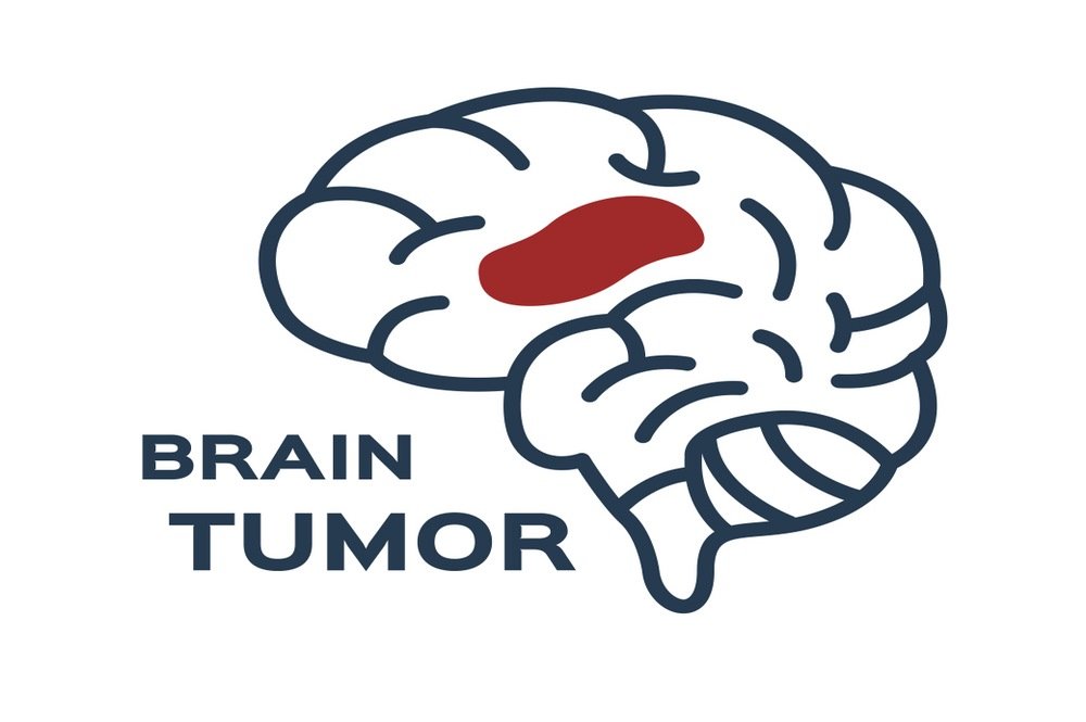 Myths about brain tumors