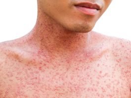 When To Worry About Skin Rash In Adults & Childerns? Skin Rash : Definition, Rash Symptoms, Common causes Of Rashes, 22 Common Skin Rashes Types, Diagnosis , Prevention,Treatment ( Medication & Home Remedies )