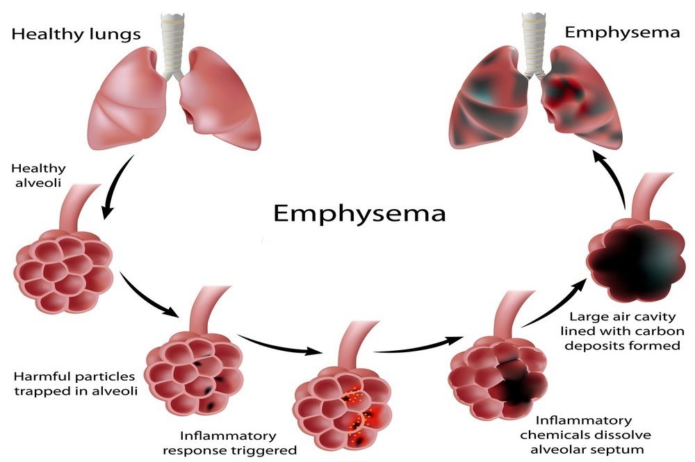 Emphysema Stages