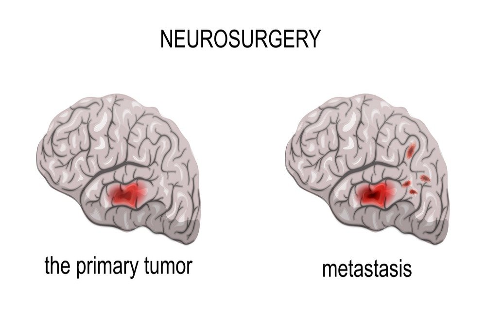 The Types Of Brain Tumors