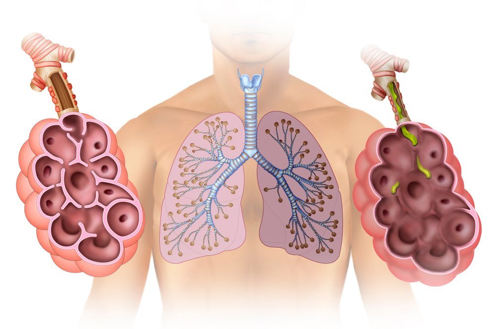 Emphysema Types