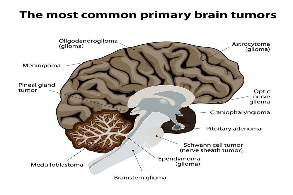 Brain Tumor : Definition, Symptoms, Causes, Risk Factors, Types ...