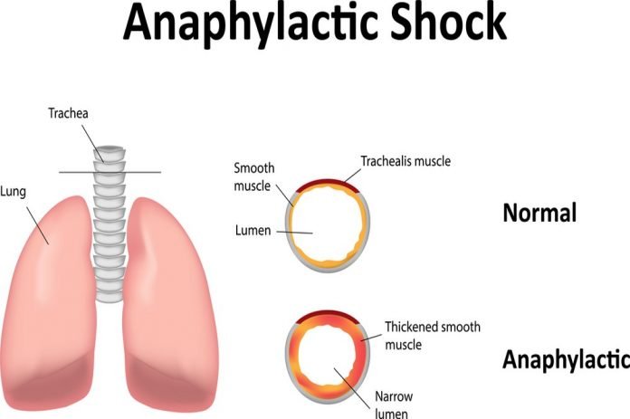 Anaphylaxis and anaphylactic shock