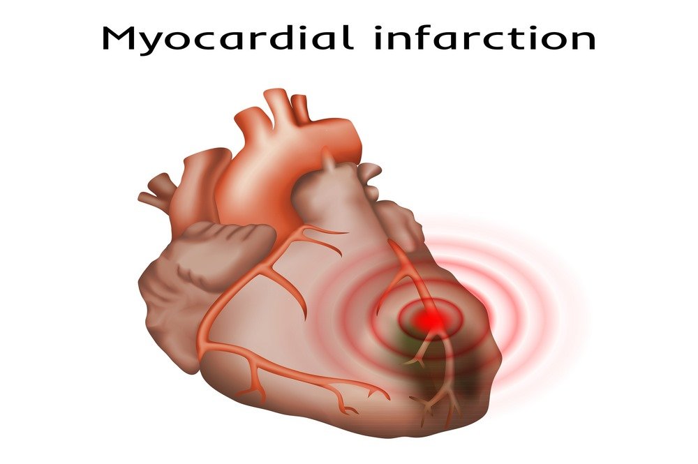 Cardiovascular complications