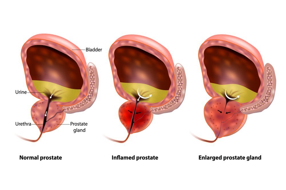 Enlarged prostate or prostate cancer