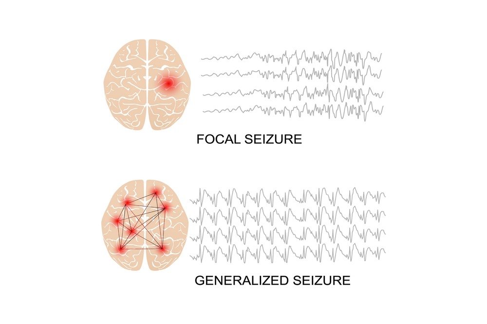 Generalized onset epilepsy
