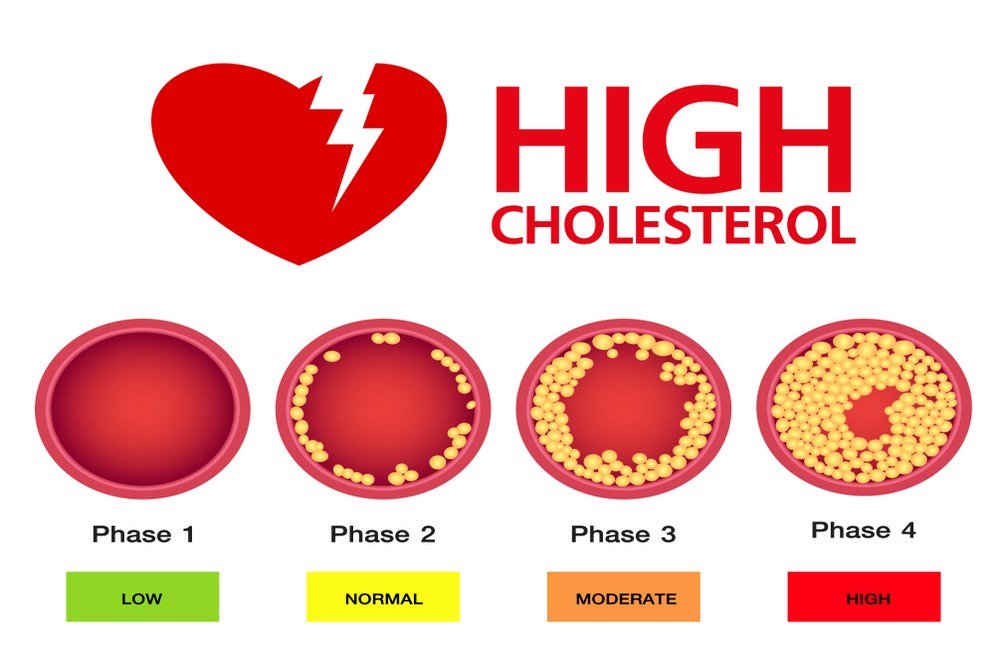High cholesterol