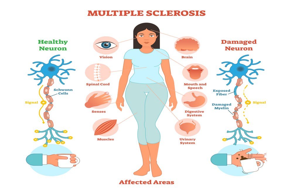 Multiple sclerosis