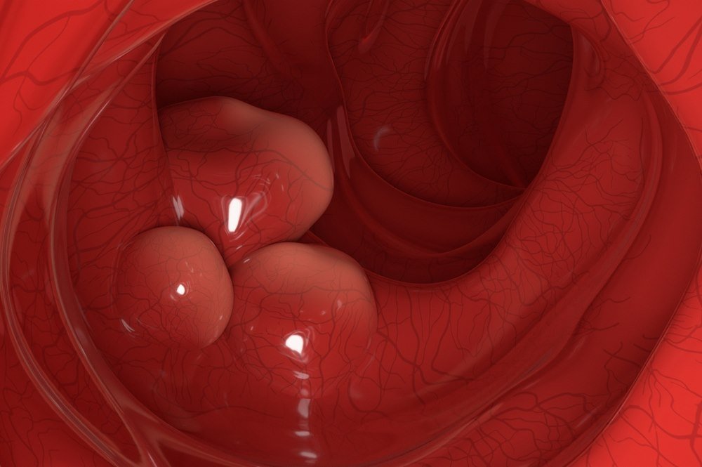 What is the prognosis of colon cancer?