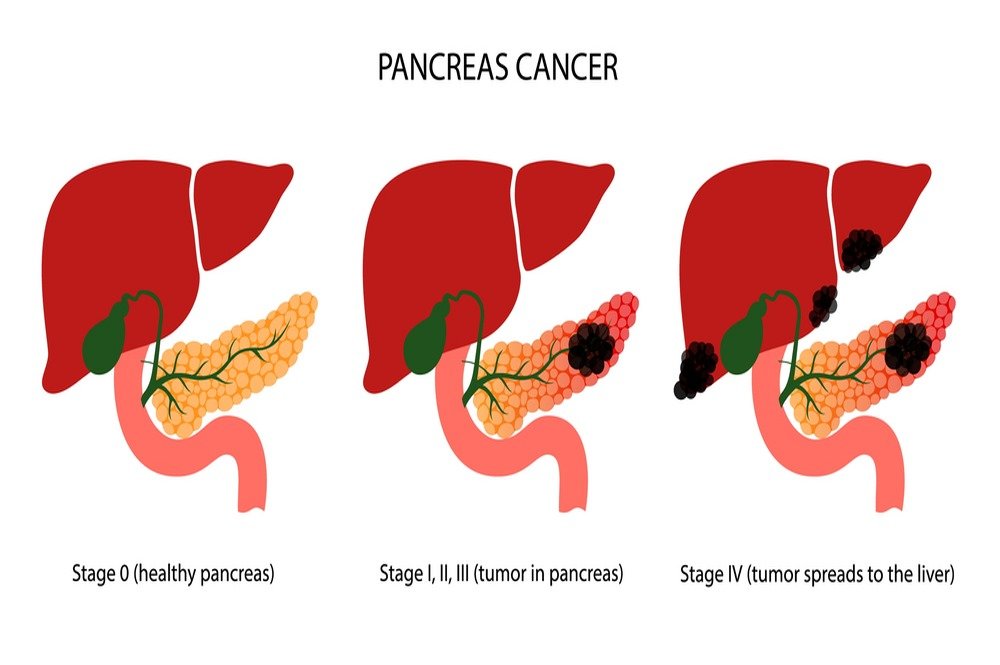 How do doctors determine stages of pancreatic cancer?