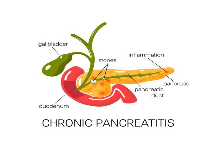 Mechanisms underlying development of pancreatic cancer