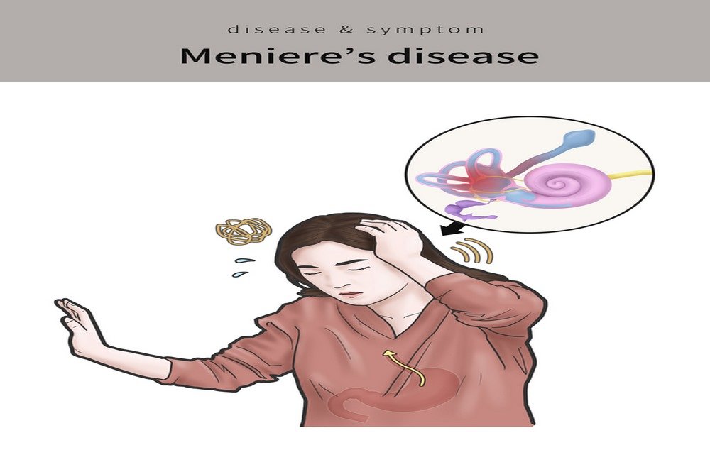 Meniere’s disease