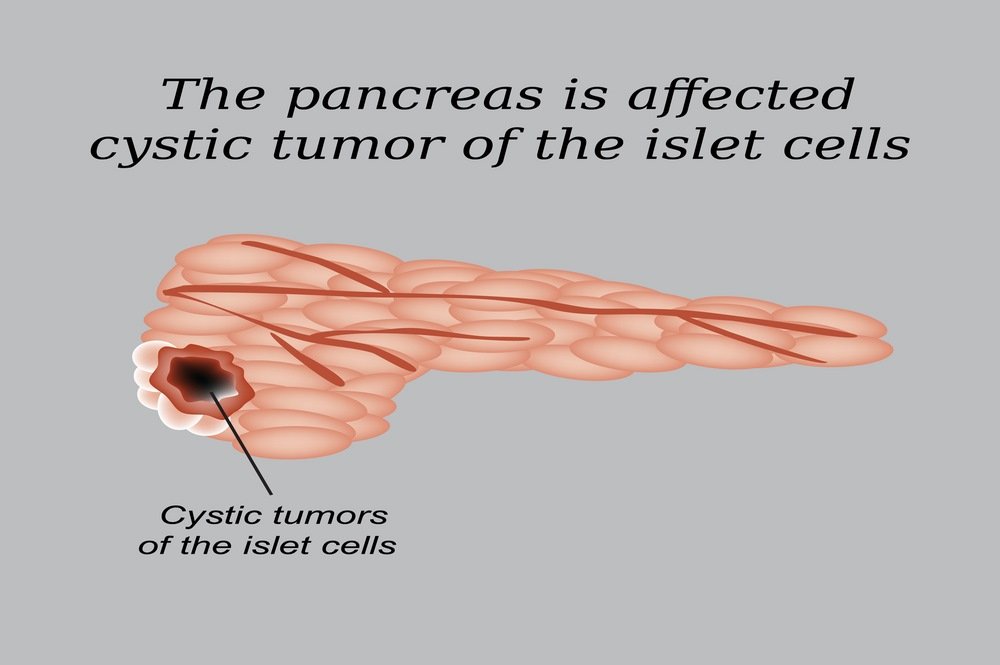 Pancreatic cysts