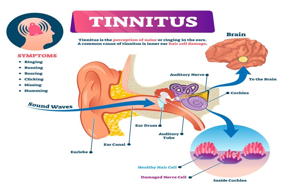 Tinnitus : Definition, Symptoms, Causes, Types, Risk Factors, Diagnosis, Complications, Treatment, Home Remedies & Prevention