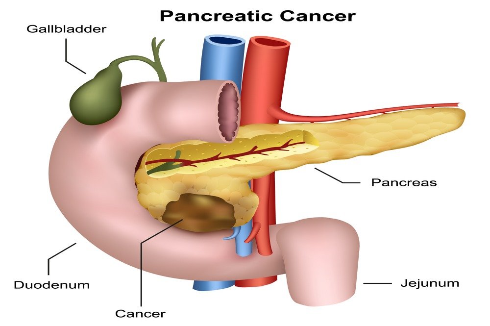 Types of pancreatic cancer