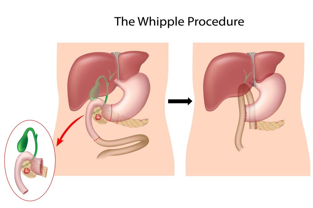 Wipple procedure