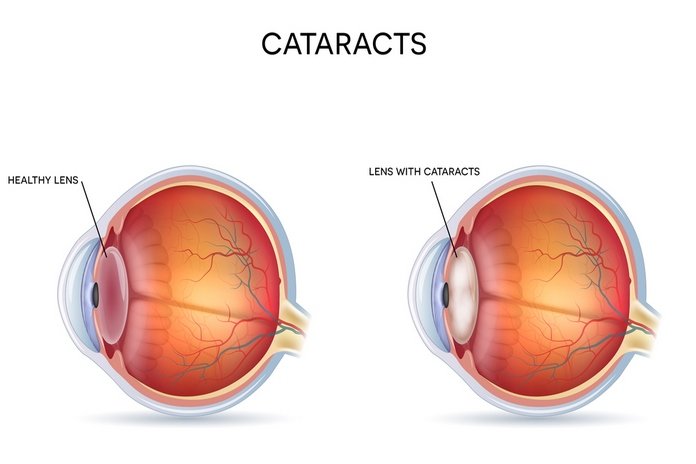 What Are Cataracts? Definition, Symptoms, Causes, Types, Risk Factors, Diagnosing, Cataracts Surgery, Cataracts Surgery Recovery, Cataracts Surgery Cost, Cataracts Prevention