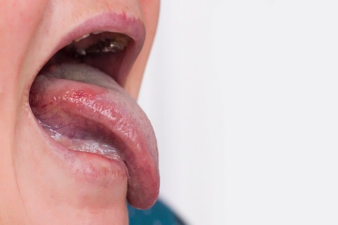 Mouth ulcers and glossitis