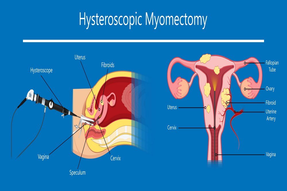 Myomectomy 
