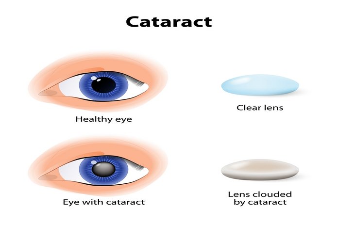 Pathophysiology of cataract