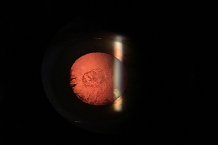 Posterior sub capsular cataracts: 