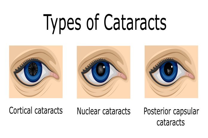 Cataracts Types