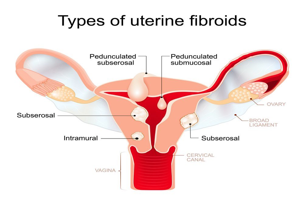 Uterine Fibroids Types