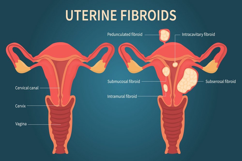 Uterine Fibroids: Definition, Symptoms, Causes, Types, Natural Treatment, Herbal Remedies, Medical Treatment