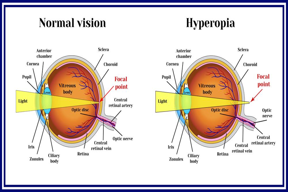 Causes of Hyperopia