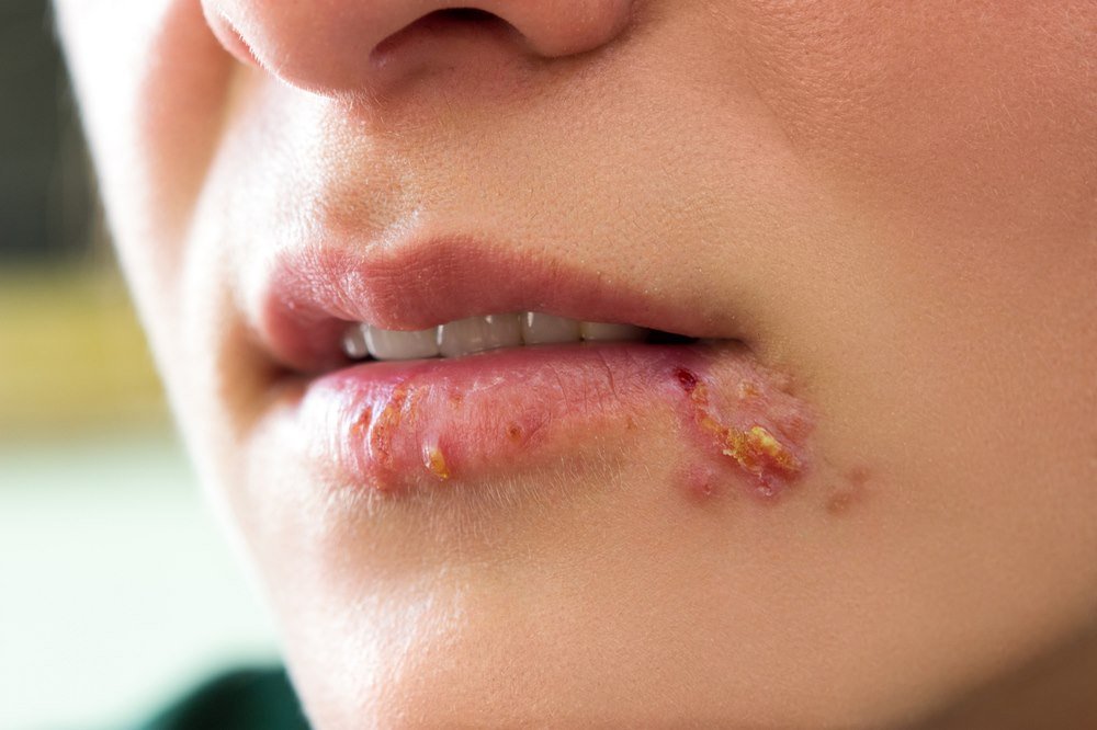 Cure Cold sores (herpes labialis)