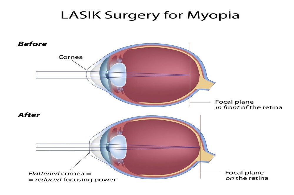 How LASIK cures nearsightedness