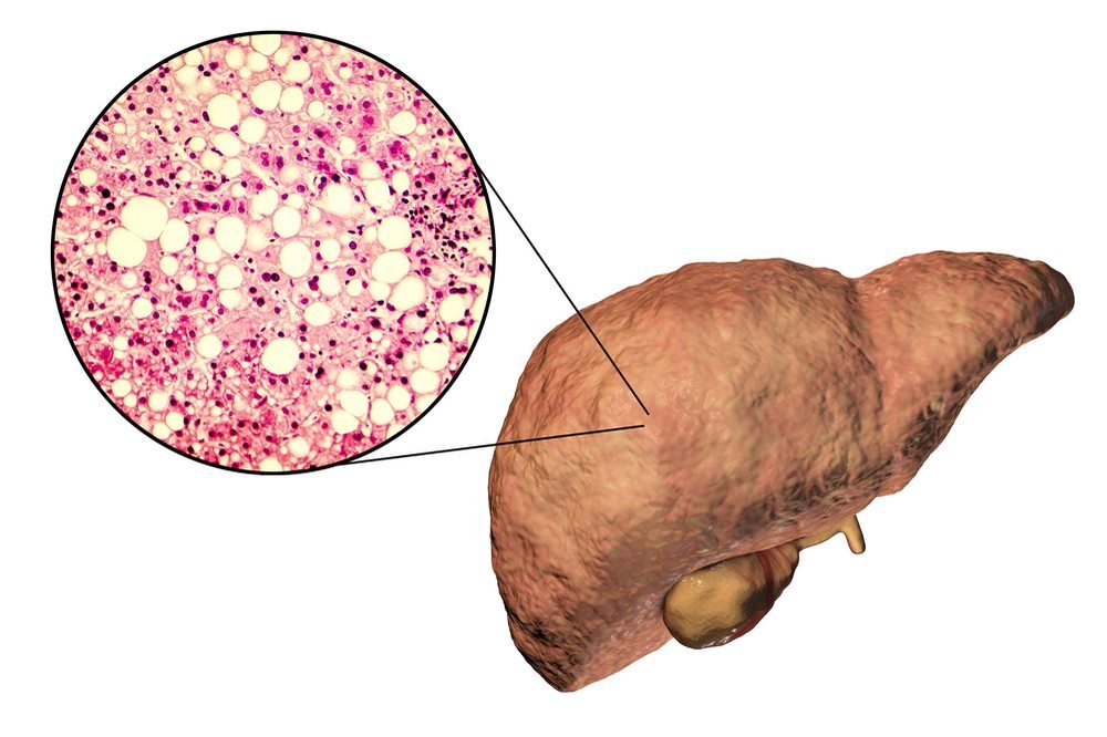 Liver disorders