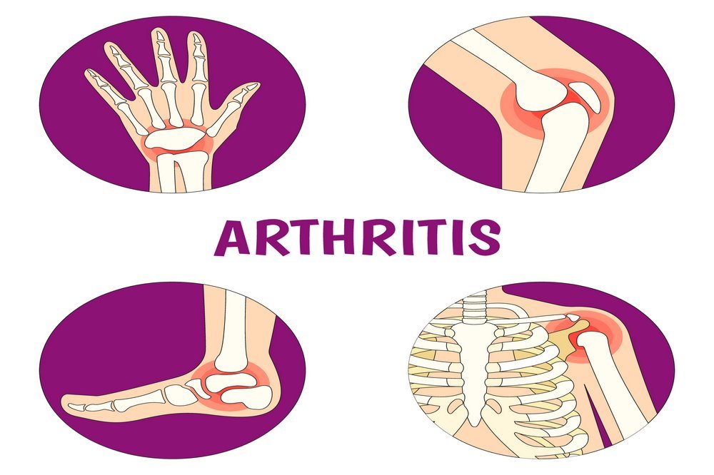 Relieve from Arthritis symptoms