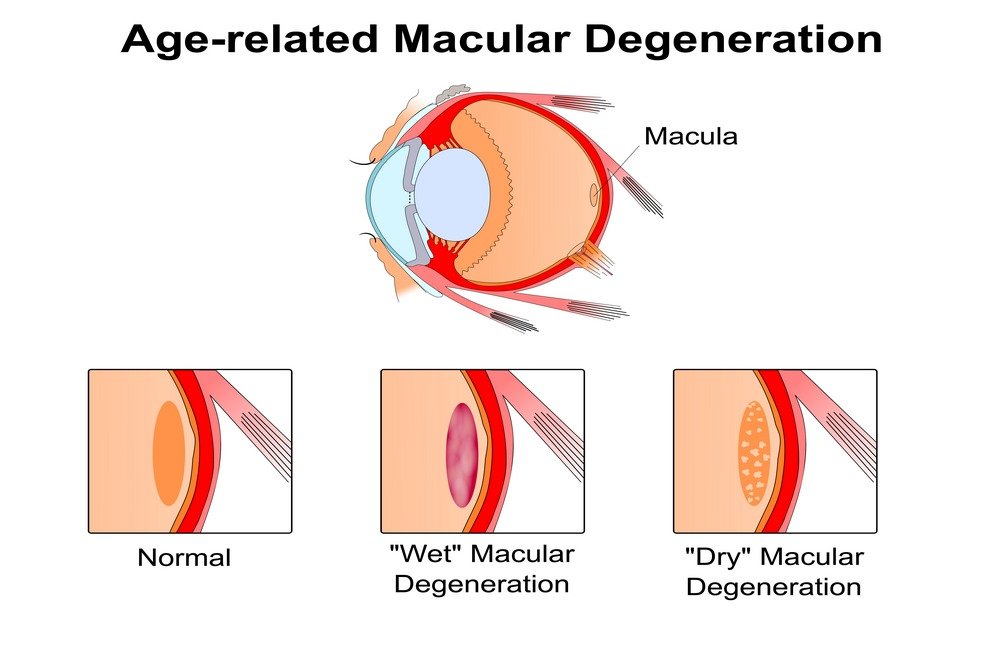 Treatment of cataract and age-related macular degeneration (AMD)
