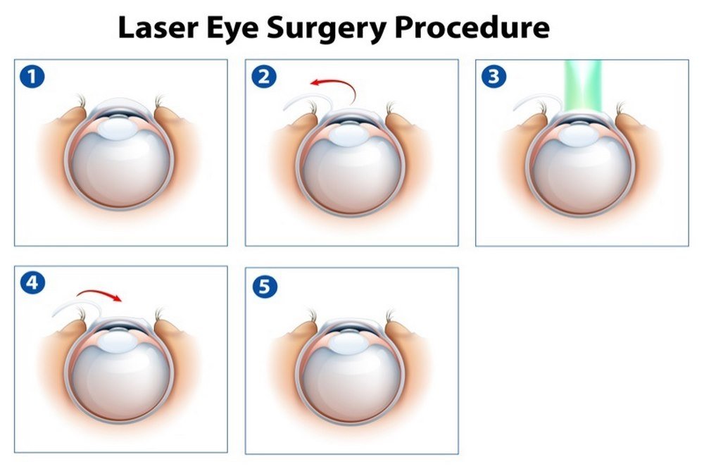 What occurs during LASIK surgery?