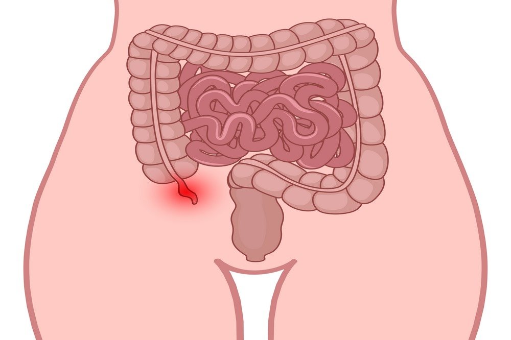 Bowel blockage (obstruction)