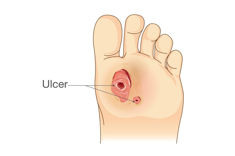 Foot ulcers