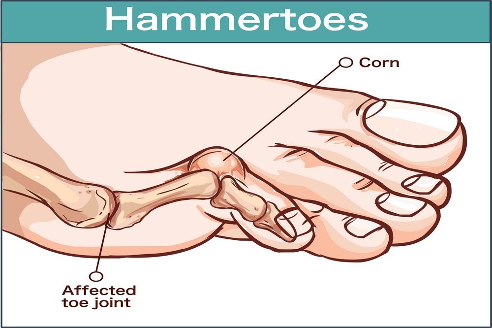 Hammer toe